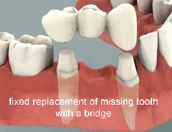 dental bridges