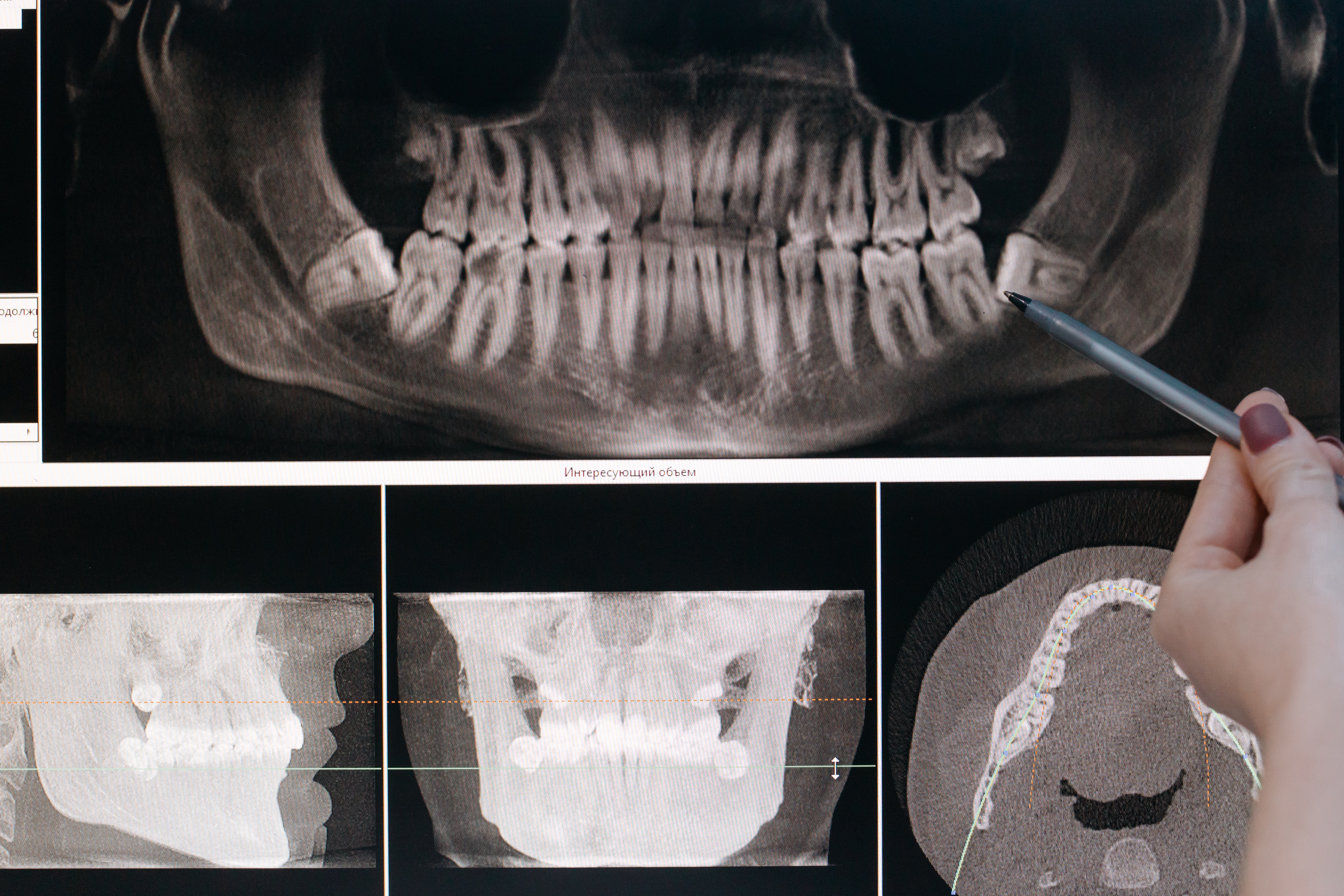 panoramic xray