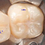 fissure sealant