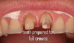 teeth for full crowns