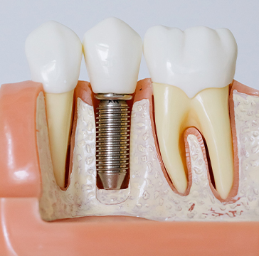 dental implants