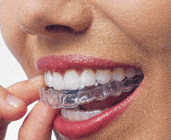 mouthguard